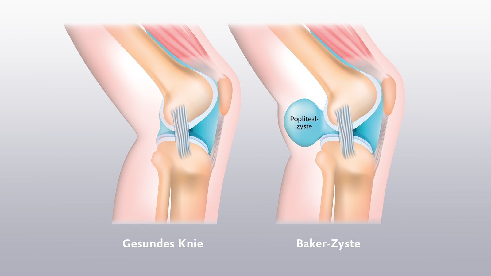 Gesundes Knie und Knie mit Bakerzyste